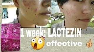 1 week taking Lactezin  LACTEZIN REVIEW the best anti acne pill super effective [upl. by Millicent]