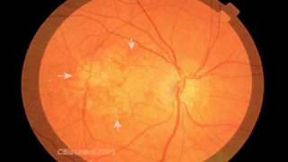 Macular Degeneration and the Aging Retina [upl. by Phillipp]