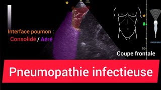 Pneumopathie Consolidation Échographie pulmonaire [upl. by Ful]