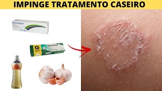 IMPINGE TRATAMENTO CASEIRO [upl. by Edalb]