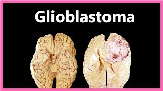 Glioblastoma Multiforme – Symptoms Diagnosis and Treatment ✔ [upl. by Akinihs]