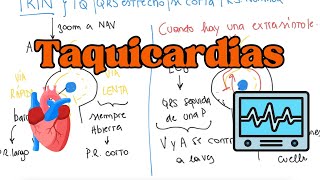 FISIOPATOLOGÍA de las ARRITMIAS con sus TRATAMIENTOS [upl. by Crysta]