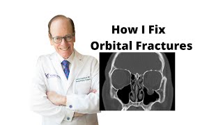 Orbital Fractures 101  Oculoplastic Surgeon Explains Orbital Fracture Surgery [upl. by Oinolopa]