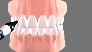 Gingivectomy Laser [upl. by Sclater]