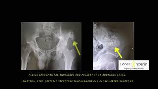 Bone Cancer TreatmentPelvis ChondrosarcomaLimb Salvage SurgeryHemipelvectomy by Dr Srimanth B S [upl. by Ingold]