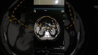 Hydronephrosis  Findings of kidney  Scan of kidney  Medical Imaging  CT Scan  Calculi of kidney [upl. by Vanden]