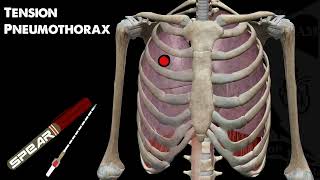 Tension Pneumothorax Education and Management [upl. by Hultin]