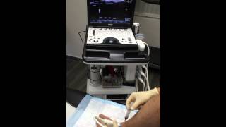 Musculoskeletal Ultrasound Guided Hydrodissection of Lateral Ankle with PRP [upl. by Sivahc]