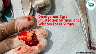 Dentigerous Cyst Enucleation Surgery and Wisdom Tooth Surgery [upl. by Albert]