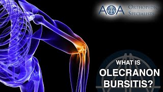 AOA Orthopedic Specialists  Olecranon Bursitis [upl. by Rudich821]