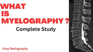 What is Myelography Myelography Xray Procedure  Myelography Radiology Procedure  In Urdu Hindi [upl. by Helprin478]