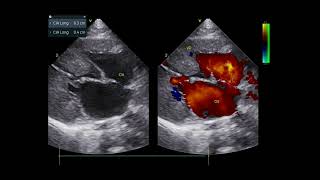 ASD PHT and hypertrophic phenotype in young cat [upl. by Nolte]