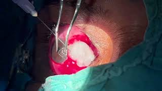 Modified Pterygium Surgery  Wills Hospital USA with Conjuctival Autograft using Mitomycin C [upl. by Blair]