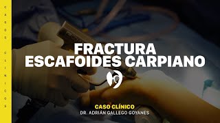 Fractura de escafoides [upl. by Can]