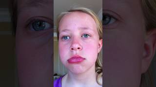 some allergic reactions for ya allergicreaction allergy allergyawareness [upl. by Ashlie]