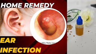 Ear Pain Remedy  Homemade oil for ear infection  Natural remedy for ear ache earache earpain [upl. by Etram]