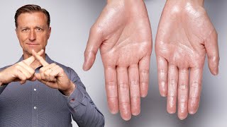 How to Stop Excessive Sweating Hyperhidrosis [upl. by Lyndel]