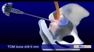 DB 115 Endoskopische Bandscheibenoperation  PAL 169  DB 115 Endoscopic Disc surgery  PAL 169 [upl. by Thedrick]