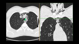 Pneumomediastinum [upl. by Yessak258]