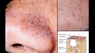 HOW BLACKHEADS amp ACNE FORM AND HOW TO GET RID OF THEM DRAW MY LIFE STYLE [upl. by Alguire789]