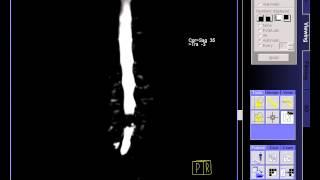 Lumbar myelography [upl. by Hajan785]