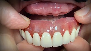 Finalizing a Highly Esthetic Denture with Dentist amp Patient InLab [upl. by Orravan]