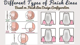 Types of Finish Lines based on Design Finish Lines in Fixed Partial Denture Tooth Preparation [upl. by Eelarbed920]