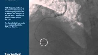 Casos Complexos de CTO  Turnpike  Line Life Cardiovascular [upl. by Rotow]