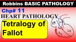 Chp11 Robbins Patho  Heart Pathology  Tetralogy of Fallot  Right to Left Shunt  Cyanotic Diseas [upl. by Elsey464]