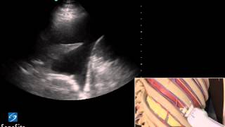 3D Lehrvideo Ultraschallgestütze Thoracentesis Untersuchung  SonoSite Ultraschall [upl. by Santa]