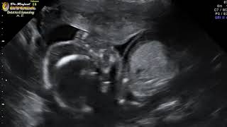 Ecografia HD 2D Diagnóstico prenatal Hidrops Fetal hidropesia Dr Rafael Ortega Muñoz Ginecologo [upl. by Tessy857]