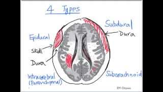 Intracranial Bleed  Part 1 [upl. by Ijan]