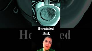 Herniated Disc [upl. by Gwenni]