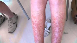 A very severe case of Sun Allergy Polymorphic Light Eruption before and 5 days after treatment [upl. by Myrle628]