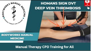 Homans Sign for Deep Vein Thrombosis DVT [upl. by Llennhoj464]