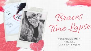 Time lapse with TADs Gummy smile correction [upl. by Suilmann]