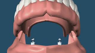 Prótese Overdenture com sistema Oring [upl. by Edee]