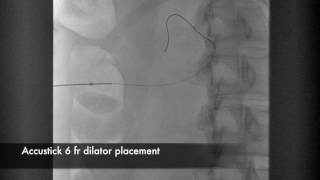 Percutaneous Nephrostomy [upl. by Shakespeare]