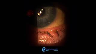 Watch implant of DURYSTA™ for patients with high eye pressure caused by glaucoma cases 1  4 [upl. by Michelsen]