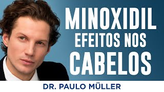 Qual Efeito Do Minoxidil Nos Cabelos – Dr Paulo Müller Dermatologista [upl. by Adniroc717]