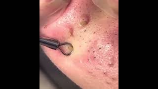 blackheads  ingrown hair [upl. by Duax]