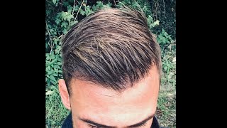 HAIR TRANSPLANT With 4500 Grafts NW45 Excellent Result With Fine Hair [upl. by Nim916]