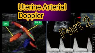 Obstetrics Doppler ultrasoundUterine artery Doppler ultrasound [upl. by Valenba313]