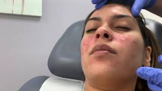 TCA CROSS for ice pick type acne scars by Dr Shaun Patel in Miami FL [upl. by Yearwood]