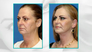 Facial Plastic Surgery Before and After 15 Years Younger Facelift facial fat transfer eyelid [upl. by Denton]