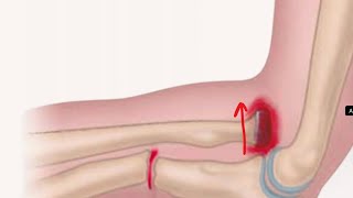 Monteggia fracture dislocation  NEET Ortho shots  ORTHO for medical students  Named fractures [upl. by Nataniel]