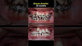 Braces for crowded teeth braces orthodontist dentistry dentist [upl. by Idihsar]