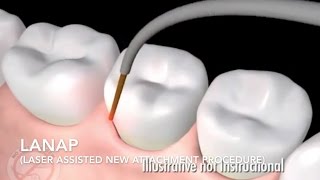 How Does Laser Surgery Work Treat Gum Disease  LANAP [upl. by Frulla218]