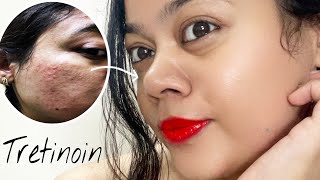 TRETINOIN Before amp After  My skin Transformation with Tretinoin pimple acnetreatment [upl. by Slaby]