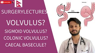 VOLVULUS  INTESTINAL OBSTRUCTION  SURGERY LECTURES  STUDY WITH MEDBRO [upl. by Sunny]